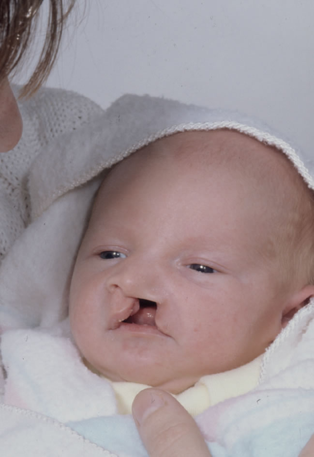 Complications De Grossesse