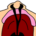 Fissure labio-palatine bilatérale