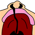 Fissure labio-palatine unilatérale
