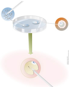 Fécondation in vitro en clinique de fertilité (FIV)