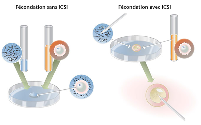 Fécondation in vitro en clinique de fertilité (FIV)