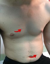 Neurofibromes cutanés chez un adolescent
